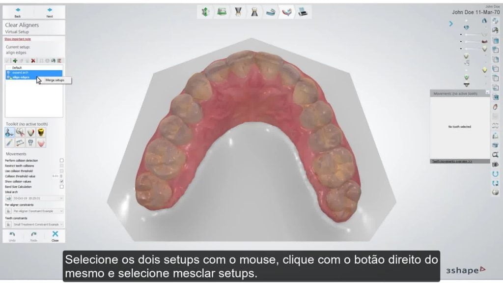 3Shape Clear Aligner Studio – Setup and Subsetup Manipulation BR PT –  Integrated Dentistry & Orthodontics